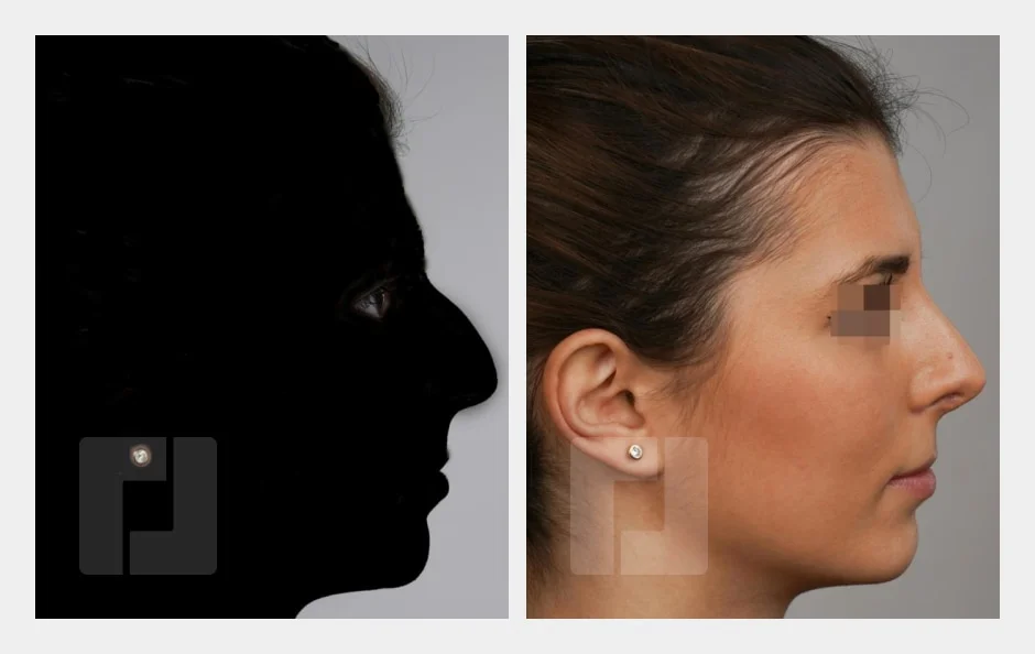 Profil vor der Nasenkorrektur als Schattenbild (links) und nach der Nasenkorrektur (rechts)
