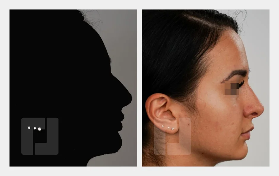 Profil vor der Nasenkorrektur als Schattenbild (links) und nach der Nasenkorrektur (rechts)