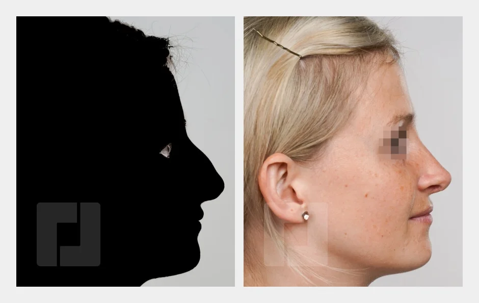Profil vor der Nasenkorrektur als Schattenbild (links) und nach der Nasenkorrektur (rechts)