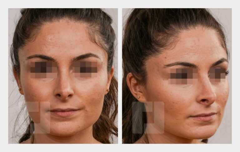 Nasenrückenreduktion, Nasenrückenrekonstruktion, Nasenspitzenreduktionsplastik, Septumkorrektur