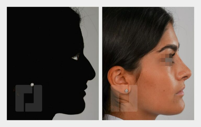 Schiefnasenkorrektur, Nasenrückenreduktion, Nasenrückenrekonstruktion, Nasenspitzenplastik, Septumkorrektur
