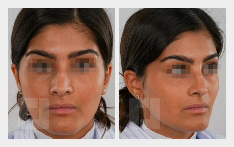 Schiefnasenkorrektur, Nasenrückenreduktion, Nasenrückenrekonstruktion, Nasenspitzenplastik, Septumkorrektur