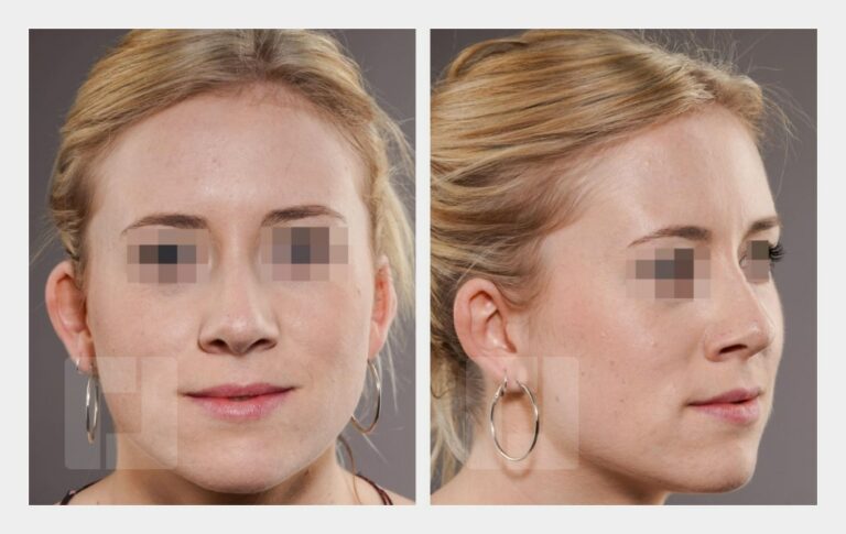 Schiefnasenkorrektur, Nasenrückenreduktion, Nasenrückenrekonstruktion, Nasenspitzenplastik, Nasenspitzenrotation, Septumkorrektur