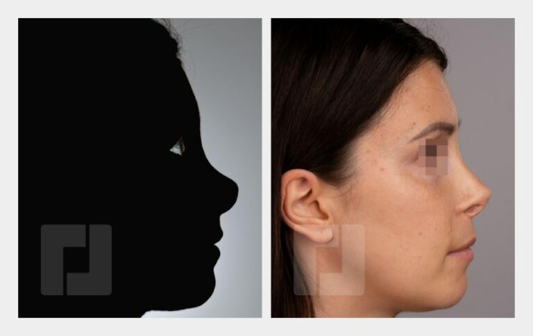 Revisionsrhinoplastik, Nasenrückenaufbau mit Ohrknorpel und Faszia lata (auswärtige Voroperation)