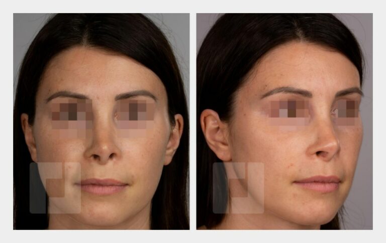 Revisionsrhinoplastik, Nasenrückenaufbau mit Ohrknorpel und Faszia lata (auswärtige Voroperation)