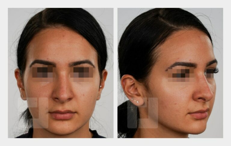 Nasenrückenreduktion, Nasenrückenrekonstruktion, Nasenspitzenplastik, Septumkorrektur