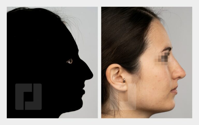 Nasenrückenreduktion, Nasenrückenrekonstruktion, Nasenspitzenreduktionsplastik (Tongue-in-Groove), Septumkorrektur