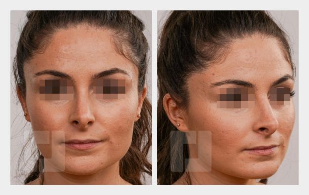 Nasenrückenreduktion, Nasenrückenrekonstruktion, Nasenspitzenreduktionsplastik, Septumkorrektur