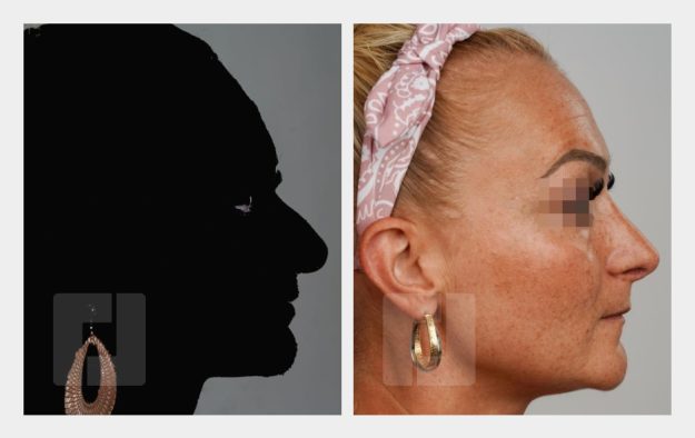 Nasenrückenreduktion, Nasenrückenrekonstruktion, Nasenspitzenreduktionsplastik, Nasenspitzenrotation, Septumkorrektur