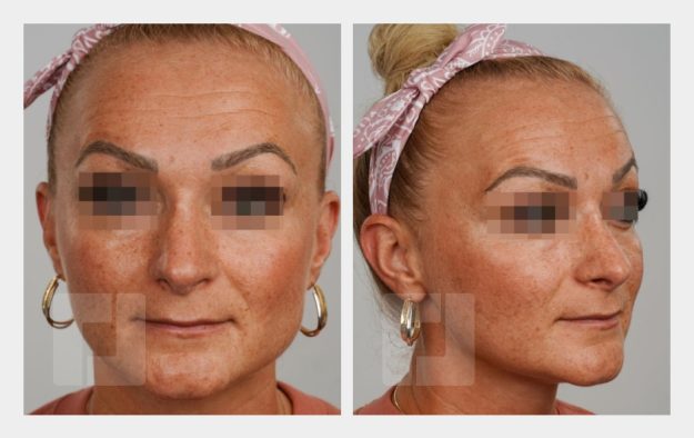 Nasenrückenreduktion, Nasenrückenrekonstruktion, Nasenspitzenreduktionsplastik, Nasenspitzenrotation, Septumkorrektur