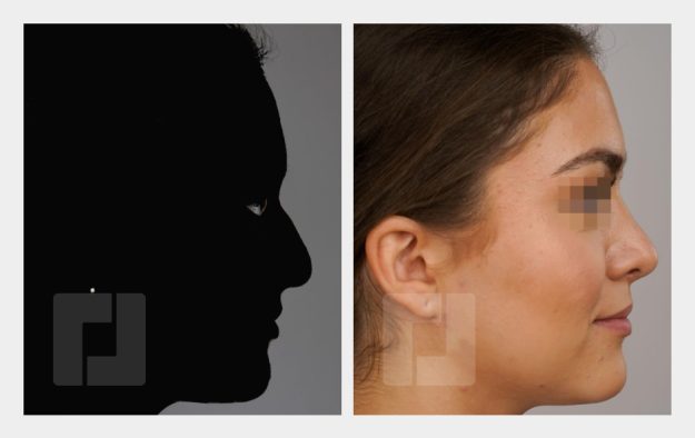 Nasenrückenreduktion, Nasenrückenrekonstruktion, Nasenspitzenaufbauplastik, Septumkorrektur