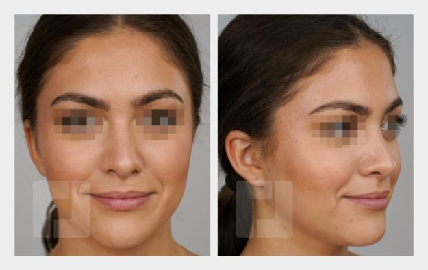 Nasenrückenreduktion, Nasenrückenrekonstruktion, Nasenspitzenaufbauplastik, Septumkorrektur