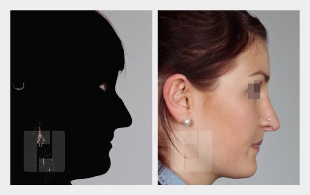 Nasenrückenreduktion, Nasenrückenrekonstruktion, Nasenwurzelaufbau, Nasenspitzenreduktionsplastik, Septumkorrektur