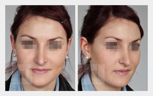 Nasenrückenreduktion, Nasenrückenrekonstruktion, Nasenwurzelaufbau, Nasenspitzenreduktionsplastik, Septumkorrektur