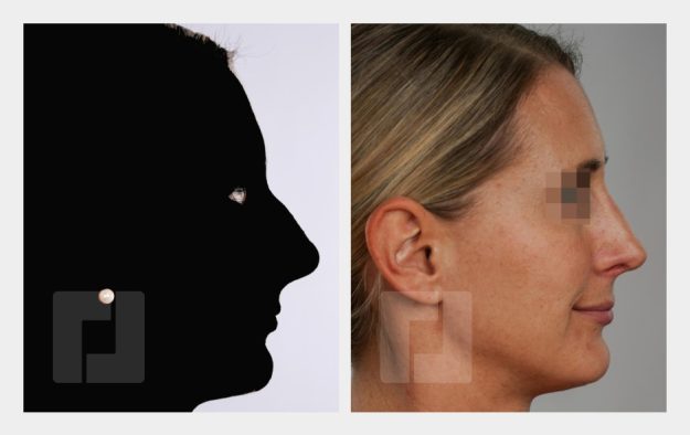 Schiefnasenkorrektur, Nasenrückenreduktion, Nasenrückenrekonstruktion, Nasenspitzenreduktionsplastik, Septumkorrektur