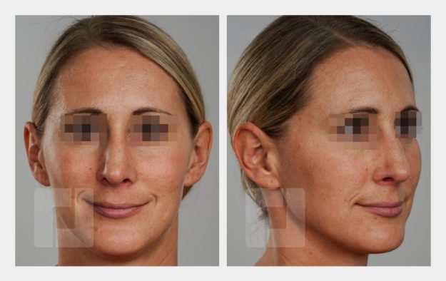 Schiefnasenkorrektur, Nasenrückenreduktion, Nasenrückenrekonstruktion, Nasenspitzenreduktionsplastik, Septumkorrektur