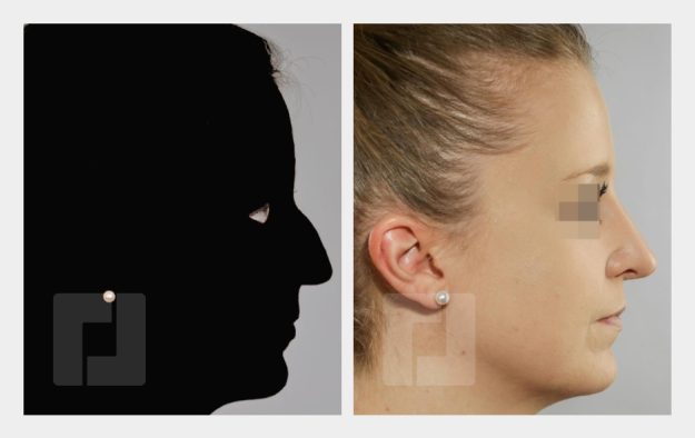 Schiefnasenkorrektur, Nasenrückenreduktion, Nasenrückenrekonstruktion, Nasenspitzenplastik, Septumkorrektur