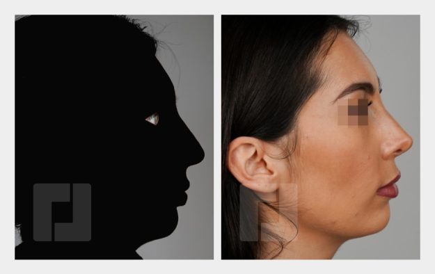 Nasenrückenreduktion, Nasenrückenrekonstruktion, Nasenwurzelreduktion, Nasenspitzenplastik, Septumkorrektur