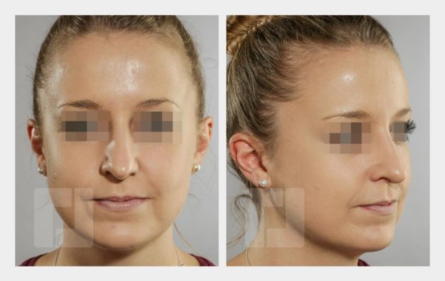 Schiefnasenkorrektur, Nasenrückenreduktion, Nasenrückenrekonstruktion, Nasenspitzenplastik, Septumkorrektur