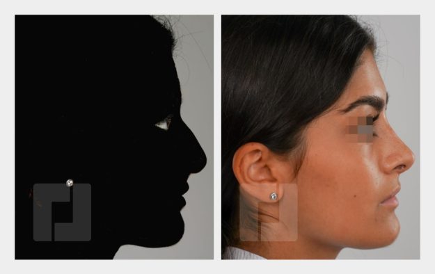Schiefnasenkorrektur, Nasenrückenreduktion, Nasenrückenrekonstruktion, Nasenspitzenplastik, Septumkorrektur