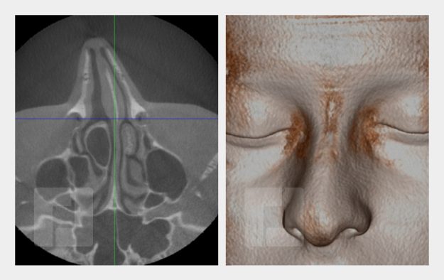 Schiefnasenkorrektur, Nasenrückenreduktion, Nasenrückenrekonstruktion, Nasenspitzenplastik, Septumkorrektur