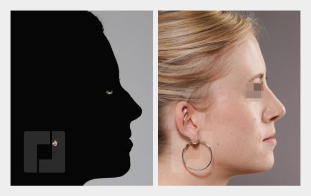 Schiefnasenkorrektur, Nasenrückenreduktion, Nasenrückenrekonstruktion, Nasenspitzenplastik, Septumkorrektur