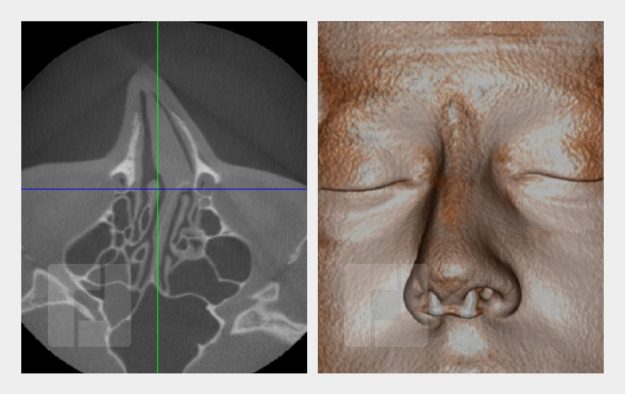 Schiefnasenkorrektur, Nasenrückenreduktion, Nasenrückenrekonstruktion, Nasenspitzenplastik, Nasenspitzenrotation, Septumkorrektur