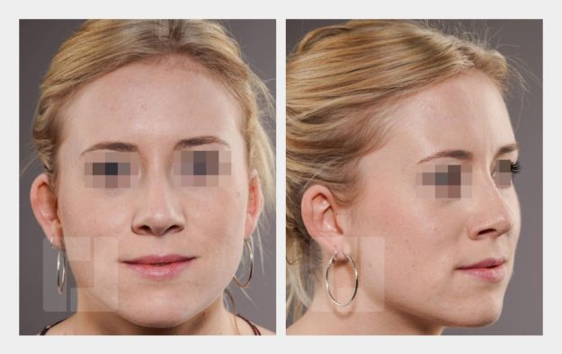 Schiefnasenkorrektur, Nasenrückenreduktion, Nasenrückenrekonstruktion, Nasenspitzenplastik, Nasenspitzenrotation, Septumkorrektur