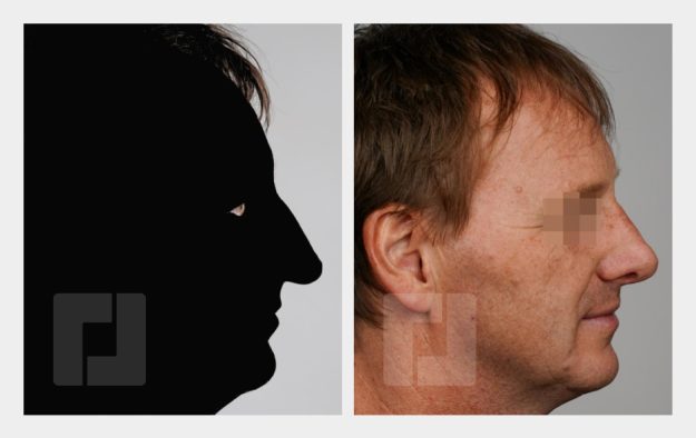 Schiefnasenkorrektur, Nasenrückenreduktion, Nasenrückenrekonstruktion, Nasenspitzenplastik, Nasenspitzenrotation, Septumkorrektur