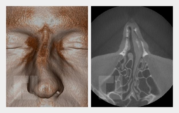 Schiefnasenkorrektur, Nasenrückenreduktion, Nasenrückenrekonstruktion, Nasenspitzenplastik, Nasenspitzenrotation, Septumkorrektur