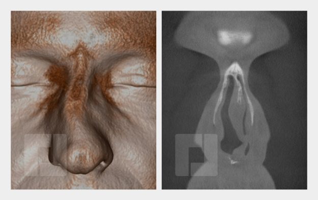 Schiefnasenkorrektur, Nasenrückenreduktion, Nasenrückenrekonstruktion, Nasenspitzenplastik, Nasenspitzenrotation, Septumkorrektur