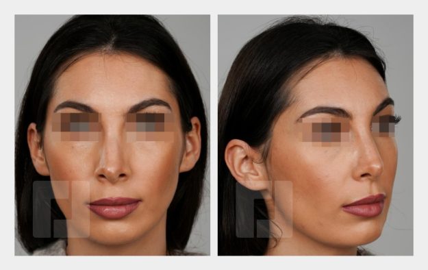 Nasenrückenreduktion, Nasenrückenrekonstruktion, Nasenspitzenplastik, Nasenspitzenrotation (Tongue-in-groove), Septumkorrektur