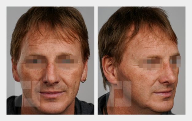 Schiefnasenkorrektur, Nasenrückenreduktion, Nasenrückenrekonstruktion, Nasenspitzenplastik, Nasenspitzenrotation, Septumkorrektur