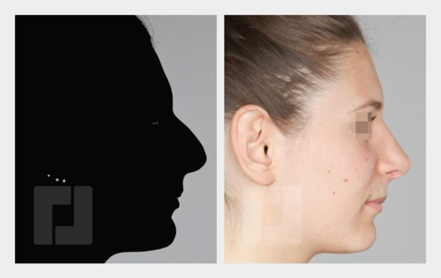 Nasenrückenreduktion, Nasenrückenrekonstruktion, Nasenspitzenplastik, Septumkorrektur