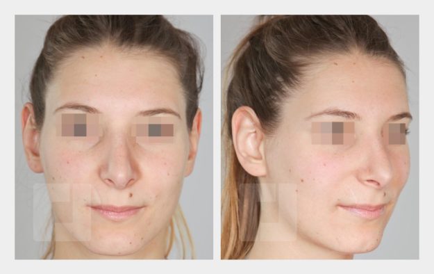 Nasenrückenreduktion, Nasenrückenrekonstruktion, Nasenspitzenplastik, Septumkorrektur