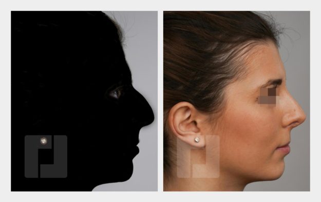 Nasenrückenreduktion, Nasenrückenrekonstruktion, Nasenspitzenplastik, Nasenspitzenrotation (Tongue-in-groove), Septumkorrektur