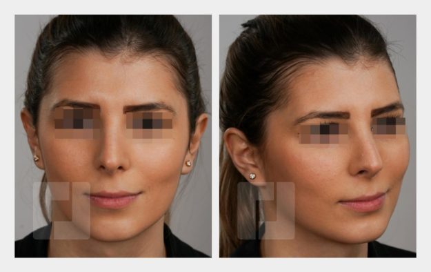 Nasenrückenreduktion, Nasenrückenrekonstruktion, Nasenwurzelreduktion, Nasenspitzenplastik, Septumkorrektur