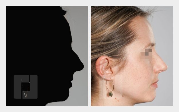 Nasenrückenreduktion, Nasenrückenrekonstruktion, Nasenspitzenplastik, Septumkorrektur