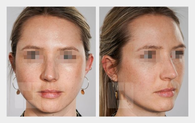 Nasenrückenreduktion, Nasenrückenrekonstruktion, Nasenspitzenplastik, Septumkorrektur