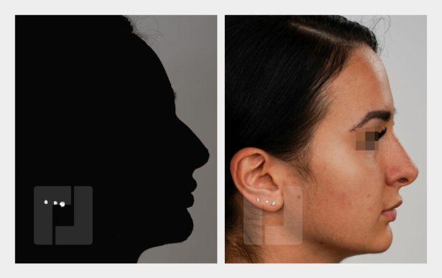 Nasenrückenreduktion, Nasenrückenrekonstruktion, Nasenspitzenplastik, Septumkorrektur