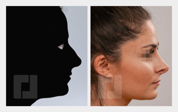 Nasenrückenreduktion, Nasenrückenrekonstruktion, Nasenspitzenreduktionsplastik, Septumkorrektur