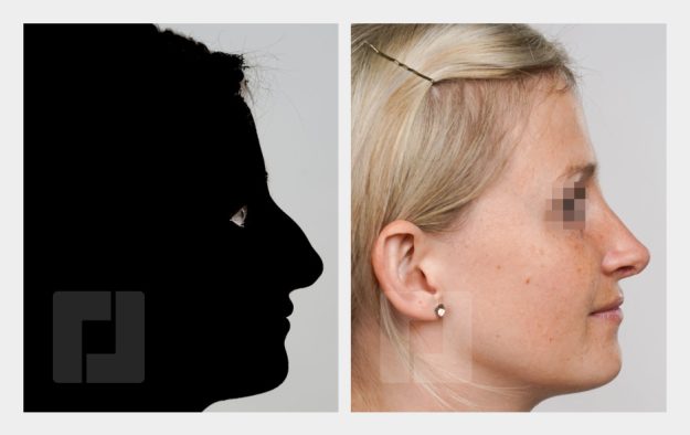 Nasenrückenreduktion, Nasenrückenrekonstruktion, Radixreduktion, Nasenreduktionsspitzenplastik, Septumkorrektur