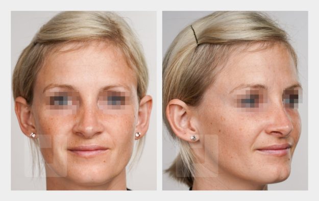 Nasenrückenreduktion, Nasenrückenrekonstruktion, Radixreduktion, Nasenreduktionsspitzenplastik, Septumkorrektur