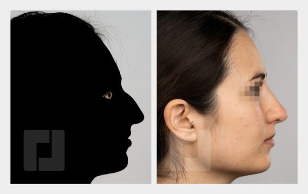 Nasenrückenreduktion, Nasenrückenrekonstruktion, Nasenspitzenreduktionsplastik (Tongue-in-Groove), Septumkorrektur