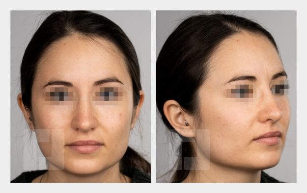 Nasenrückenreduktion, Nasenrückenrekonstruktion, Nasenspitzenreduktionsplastik (Tongue-in-Groove), Septumkorrektur